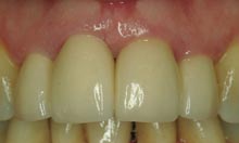 Fig-4 Renishaw new incise metal free crowns