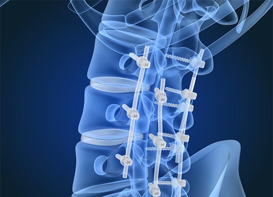 Orthopaedic implant xray